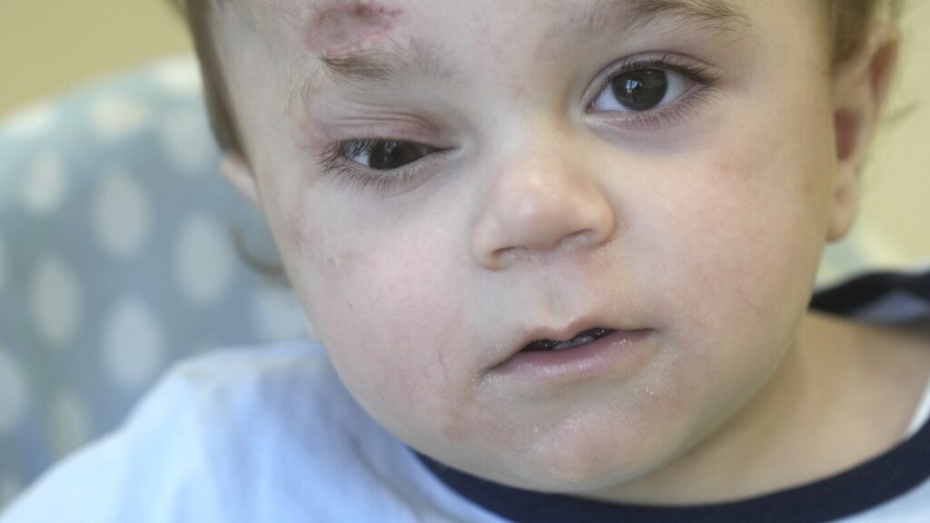 A baby evacuated from Gaza lost an eye and most of his family in the war