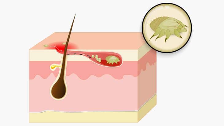 السكابيوس سكابيوس الجرب جرب scabies