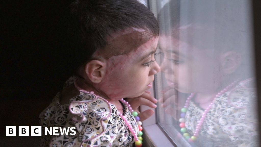 After months of waiting, Gaza girls make it to Italy for burns treatment