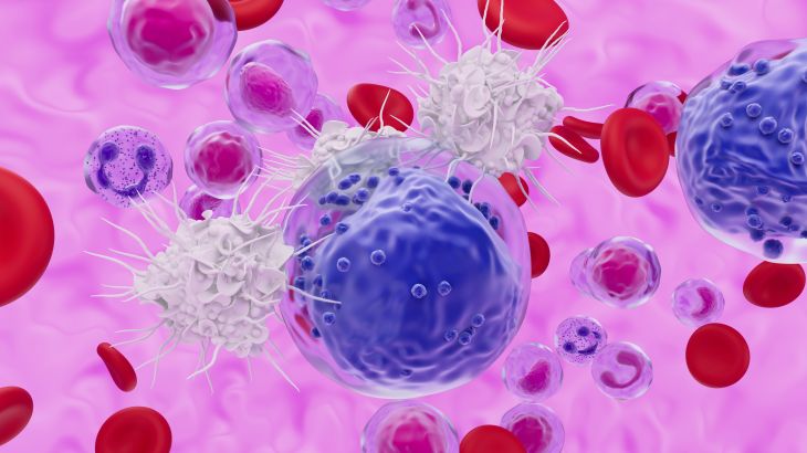 Illustration of T cell white blood cells attacking an acute myeloid leukaemia (AML) cell. This cancer affects the myeloid tissue (bone marrow), specifically the white blood cell precursors (myeloblasts) that form a type of white blood cell known as granulocytes. These immature cells fill up the bone marrow and spill into the bloodstream and circulate throughout the body. The cells do not work properly to fight infections and their increased production reduces the production of red blood cells leading to anaemia and fatigue. Acute leukaemias progress quickly. T lymphocytes, or T cells, are a type of white blood cell and a component of the body's immune system. They recognise a specific site (antigen) on the surface of a pathogen or cancerous cell, bind to it, and attract antibodies or cells to eliminate it