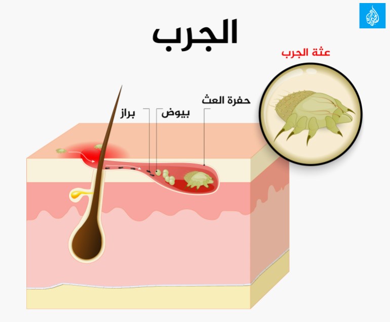 الجرب