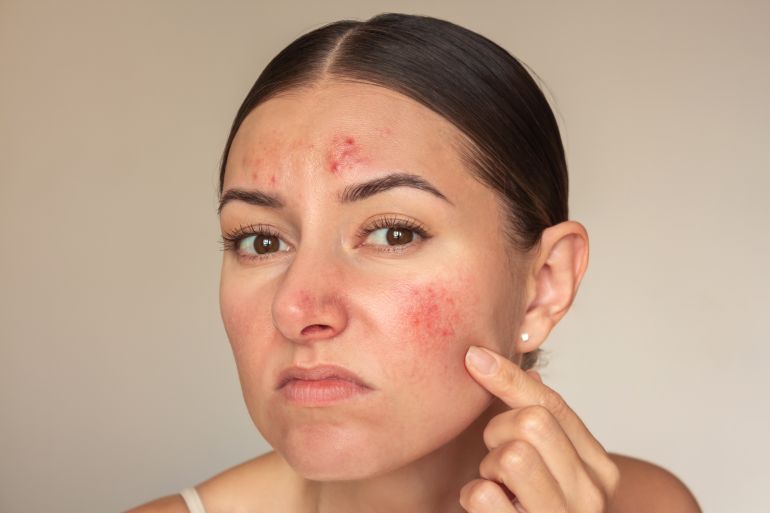 Young brunette Caucasian woman examines the pimples on her face. Girl is experiencing discomfort, suffers from a skin disease on her face-rosacea in the acute stage. Isolated on a beige background غيتي